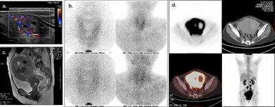 Case Report: Life-threatening hypercalcemia associated with MMR-deficient endometrial carcinoma secreting parathyroid hormone